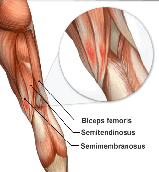 How to Fix Hamstring Pain FOR GOOD 